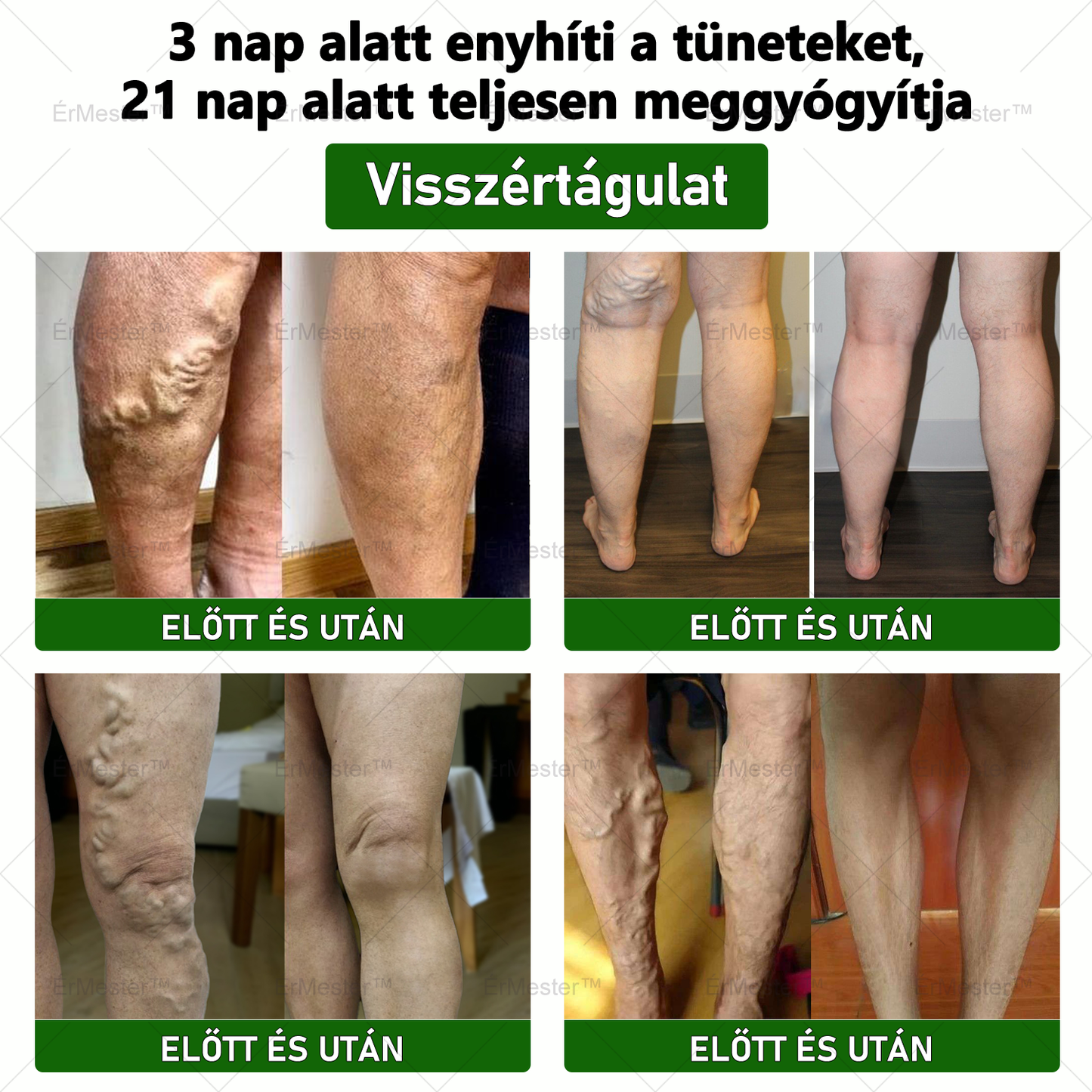 💥💥 Gratulálunk, hogy te is az első 200 rendelés egyikévé váltál! Élvezd az extra 50% kedvezményt! Cselekedj most, és teljesen gyógyítsd meg a vénás betegségeket, hogy visszanyerd az egészségedet! Ha most lemaradsz, csak jövőre lesz újabb lehetőség!