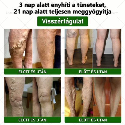 💥💥 Gratulálunk, hogy te is az első 200 rendelés egyikévé váltál! Élvezd az extra 50% kedvezményt! Cselekedj most, és teljesen gyógyítsd meg a vénás betegségeket, hogy visszanyerd az egészségedet! Ha most lemaradsz, csak jövőre lesz újabb lehetőség!