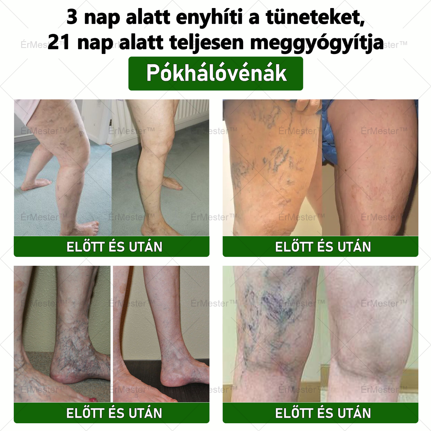 💥💥 Gratulálunk, hogy te is az első 200 rendelés egyikévé váltál! Élvezd az extra 50% kedvezményt! Cselekedj most, és teljesen gyógyítsd meg a vénás betegségeket, hogy visszanyerd az egészségedet! Ha most lemaradsz, csak jövőre lesz újabb lehetőség!